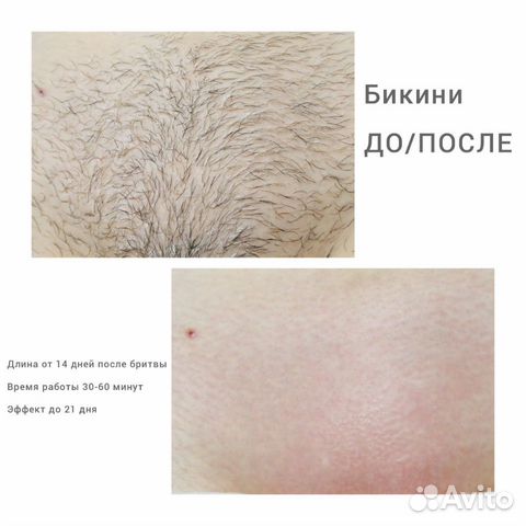 Мужская депиляция